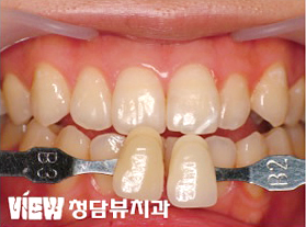 치아미백